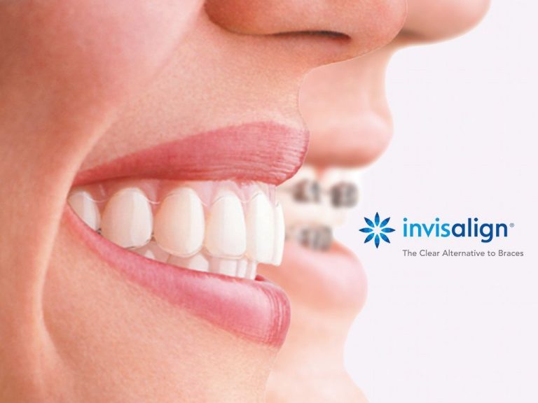 Invisalign, une technique qui vient faciliter le soin orthodontie